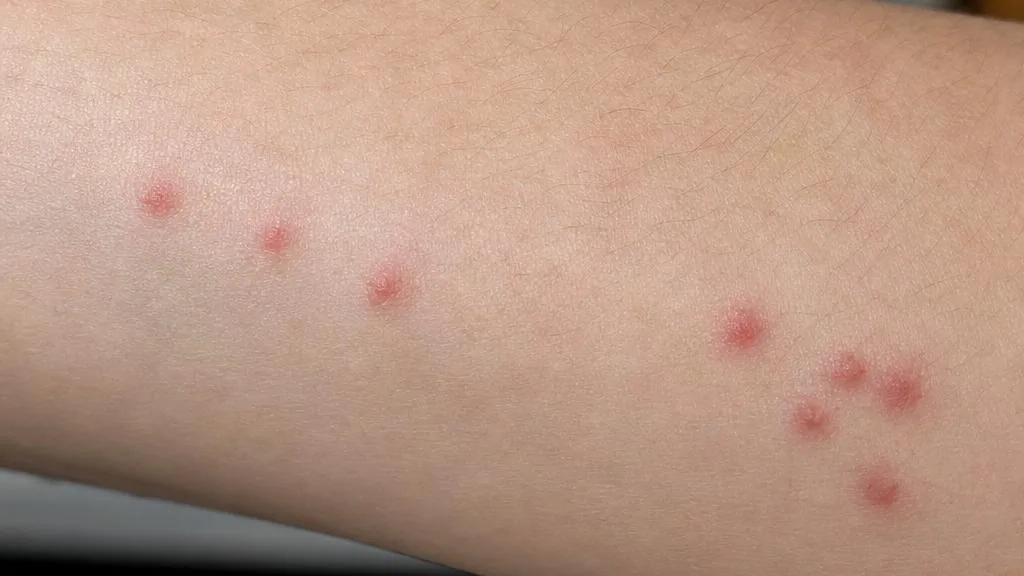 Small red bed bug bite welts arranged in a line and cluster on human skin